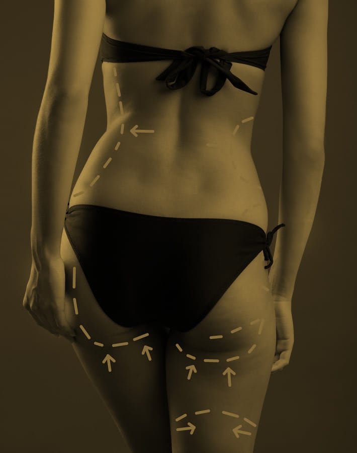 Liposuktion
